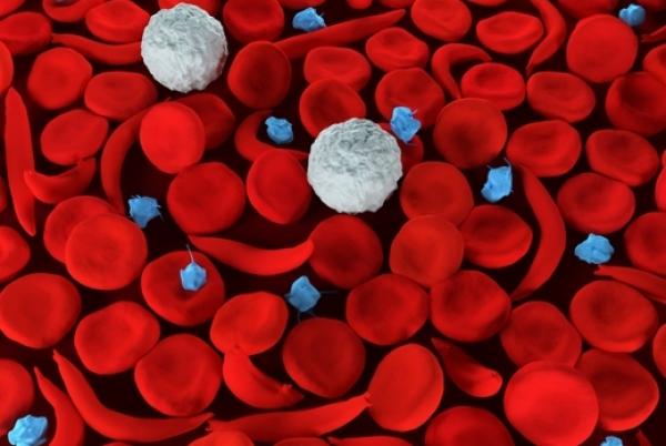 Red blood cells, some of which are sickle cells