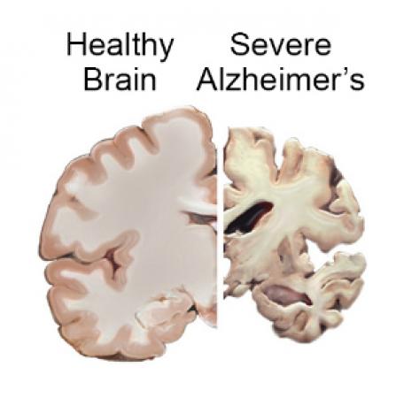 The brain of an Alzheimer's sufferer in a severe stage can show extreme destruction of brain mass. Credit: National Institutes of Health