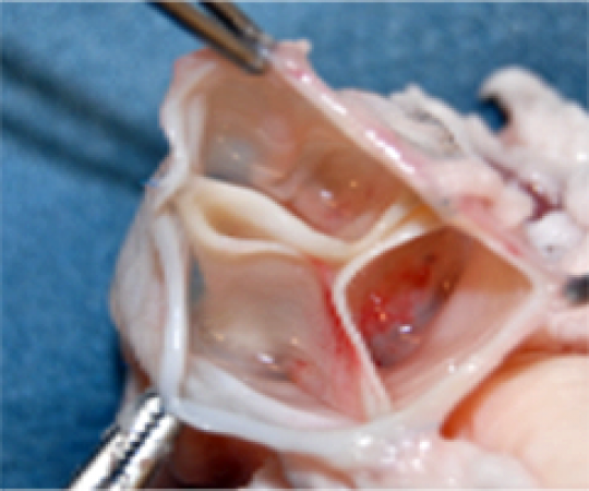 Tricuspid valve