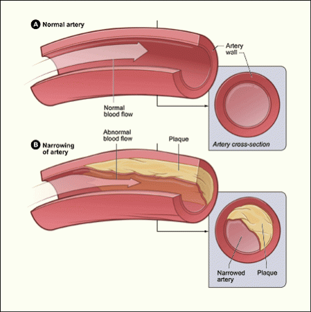 In atherosclerosis, plaque builds in arteries behind the inner lining, or epithelium, in a process involving inflammation and immune reaction complications. Credit: NIH National Heart, Lung, and Blood Institute