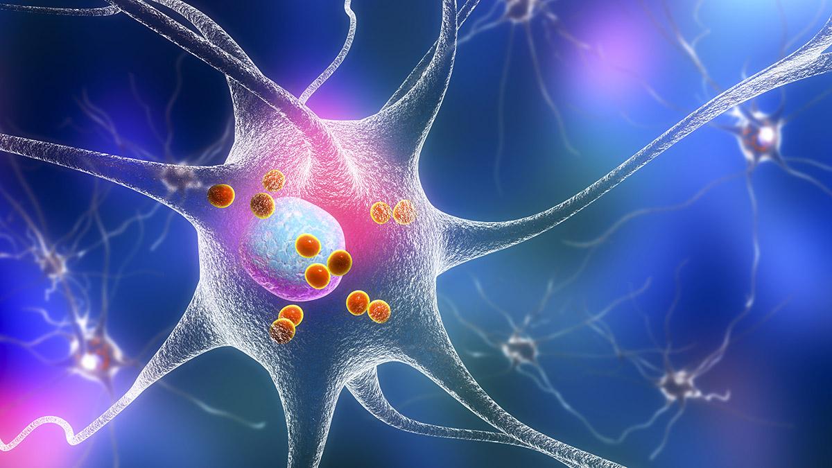 Parkinson's disease. 3D illustration showing neurons containing Lewy bodies, small red spheres which are deposits of proteins accumulated in brain cells that cause their progressive degeneration. (Licensed from Big Stock Photo)