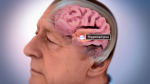 Data Detectives Shift Suspicions in Alzheimer's from Usual Suspect to Inside Villain Data Detectives Shift Suspicions in Alzheimer's from Usual Suspect to Inside Villain